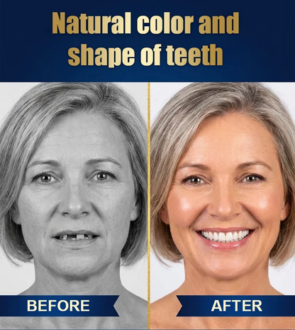 Strong Suction Full Denture for Confident Smile