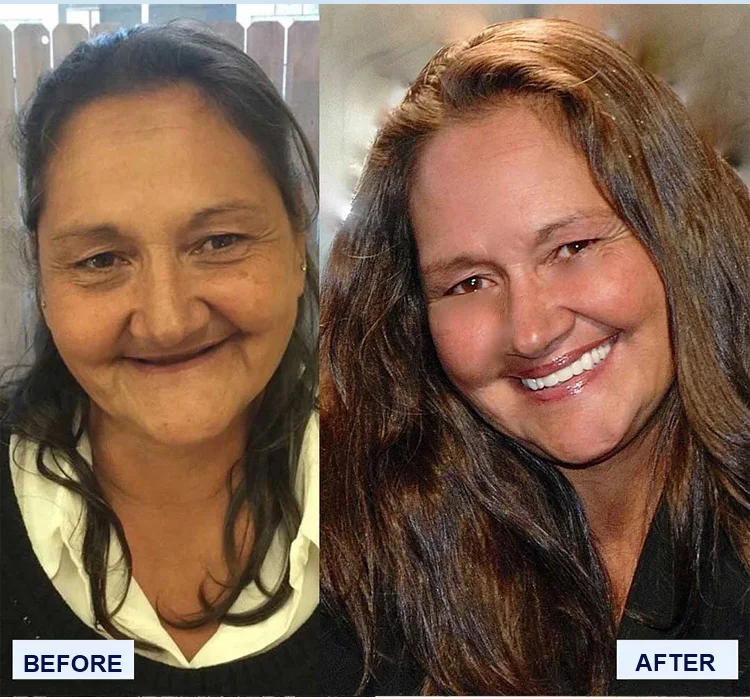 Strong Suction Full Denture for Confident Smile
