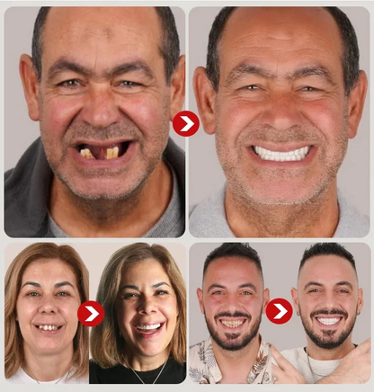Strong Suction Full Denture for Confident Smile