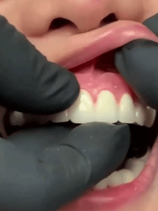 Strong Suction Full Denture for Confident Smile